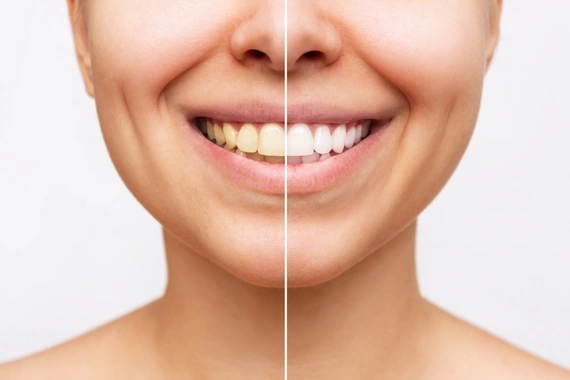 Smiling person showing bright, white teeth with confidence.