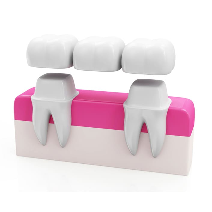 A dental bridge replacing missing teeth with natural-looking artificial teeth.