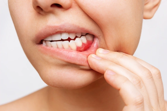 Illustration of healthy versus diseased gums highlighting periodontal issues.