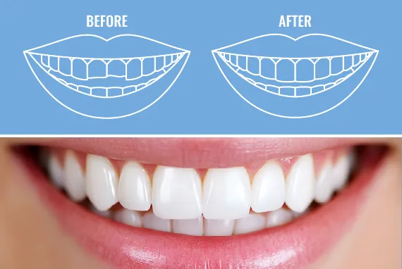 Close-up of a smile showcasing bonded, tooth-colored dental fillings.