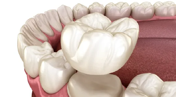 A close-up of a dental crown showcasing its esthetic design.