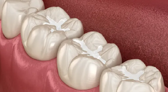 Dental fillings displayed in a variety of materials and colors.