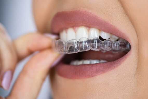 Custom night guard for teeth clenching and grinding protection.