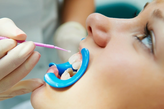 A dentist applying dental sealants to a patient's tooth.