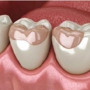 Cosmetic dental bonding repair for chipped and discolored teeth.