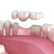 Illustration of a dental bridge connecting teeth.