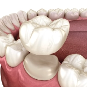 Dental crowns to restore and enhance damaged or missing teeth.