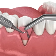 A dentist performing gum grafting treatment on a patient.