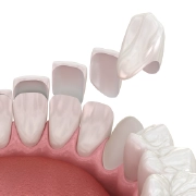 A close-up of a beautiful smile showcasing polished dental veneers.