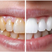 A smiling person showing bright, white teeth in a dental setting.