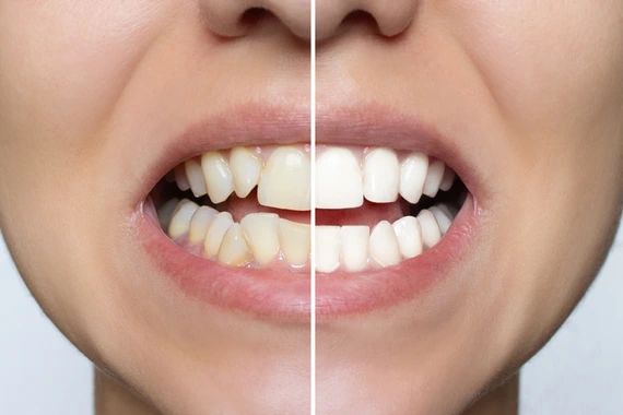 Before and after images of dental veneers enhancing tooth appearance.
