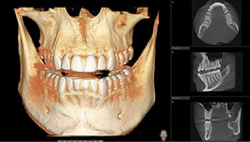 BENEFITS OF IMPLANT RESTORATIONS FROM SMILE BY DR. JOHN PAUL